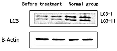 Effect of Sirolimus on the Level of Peripheral Blood Lymphocyte Autophagy in Children With Systemic Lupus Erythematosus